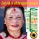 Get Rid Of Vitiligo In Kakopetria In Cyprus Call +27710732372 Scars And Stretch Marks In Australia